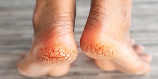 4 soins naturels pour traiter la crevasse des pieds