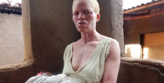 Malawi, les Albinos témoignent : "J'ai tellement peur que je ne dors plus."