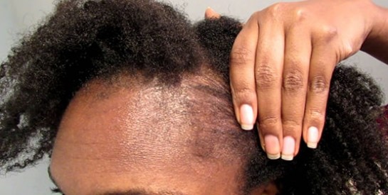 La chute des cheveux pendant la grossesse ou après l`accouchement : que faire?