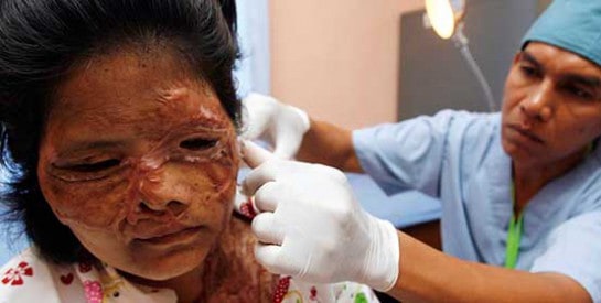 L'espoir des femmes victimes d'attaques à l'acide en Inde