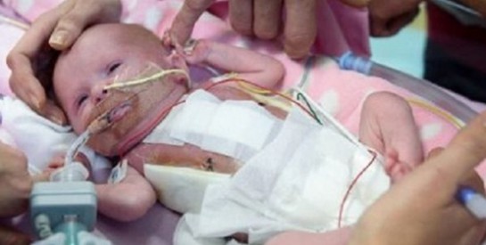 Un bébé né avec son coeur hors de la poitrine opéré avec succès