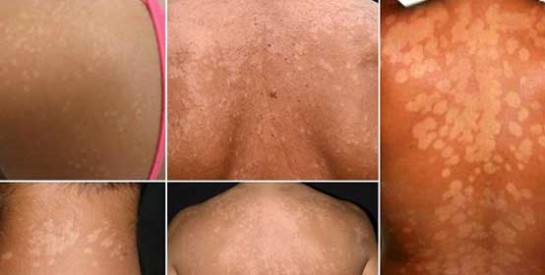 Taches blanches sur la peau ? Voici les remèdes