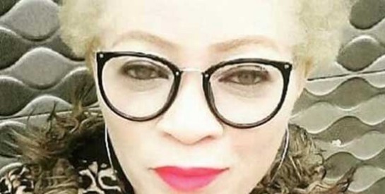 Pernelle Obame  : ``On nait albinos, on vit albinos, on mourra albinos``