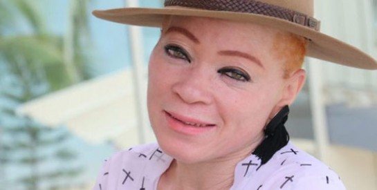 Pernelle Obame, celle qui lutte pour les droits des Albinos