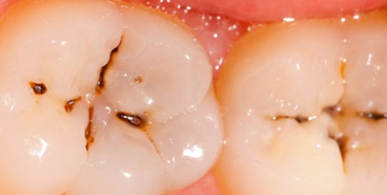 Comment guérir naturellement les caries