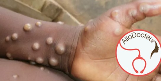 Quels sont les symptômes de la variole du singe ?