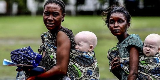Des albinos vendus pour 75 000 $US