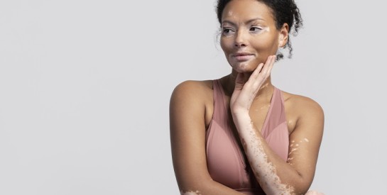 Prendre Soin d’une Peau Atteinte de Vitiligo : Hydratation, Produits et Conseils Essentiels