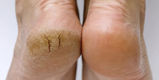 Talons fendillés : causes, prévention et soins au naturel
