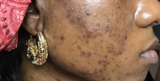 Le teint parfait : astuces pour unifier et masquer les taches d’hyperpigmentation