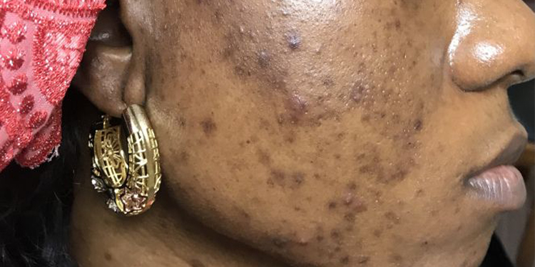 Le teint parfait : astuces pour unifier et masquer les taches d’hyperpigmentation