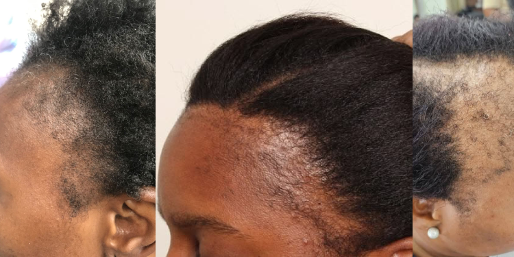 5 erreurs qui empêchent vos cheveux crépus de bien pousser