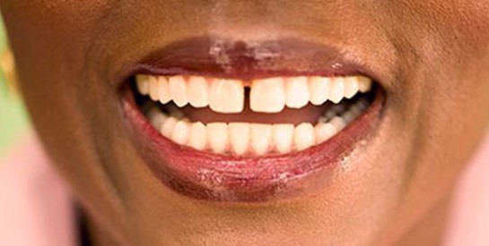 Comment faire pour retrouver mes dents blanches?