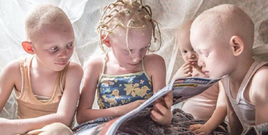 Comment stopper les crimes contre les albinos en Afrique