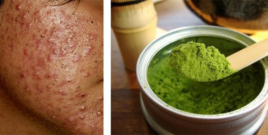 Cicatrices d`acné: des remèdes naturels pour en remédier